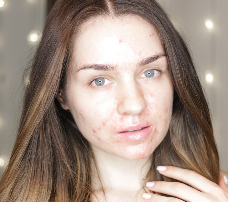 skin-before-going-on-accutane